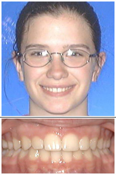 Mckinney Orthodontics After 1