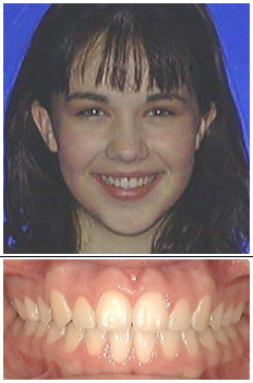 Mckinney Orthodontics After 2
