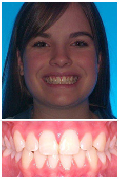 Mckinney Orthodontics After 3