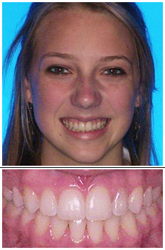 Mckinney Orthodontics After 8