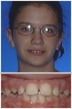 Mckinney Orthodontics Before 1