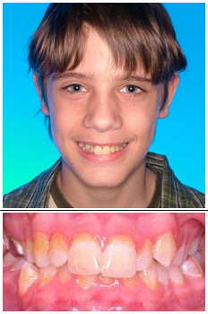 Mckinney Orthodontics Before 10