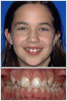 Mckinney Orthodontics Before 2
