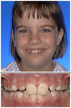 Mckinney Orthodontics Before 3