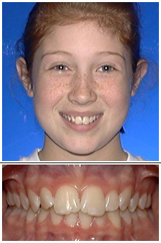Mckinney Orthodontics Before 4