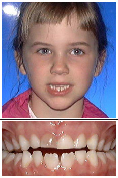 Mckinney Orthodontics Before 5