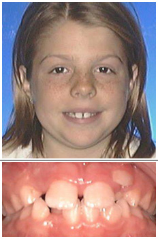 Mckinney Orthodontics Before 6