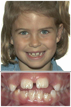 Mckinney Orthodontics Before 7