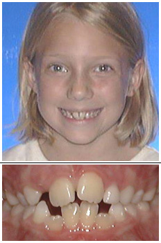 Mckinney Orthodontics Before 8