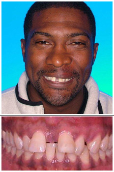 Mckinney Orthodontics Before 9