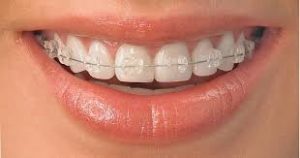 Mckinney Orthodontics Inovation 4