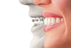 Mckinney Orthodontics Invisalign 2