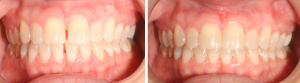 Mckinney Orthodontics Invisalign 3