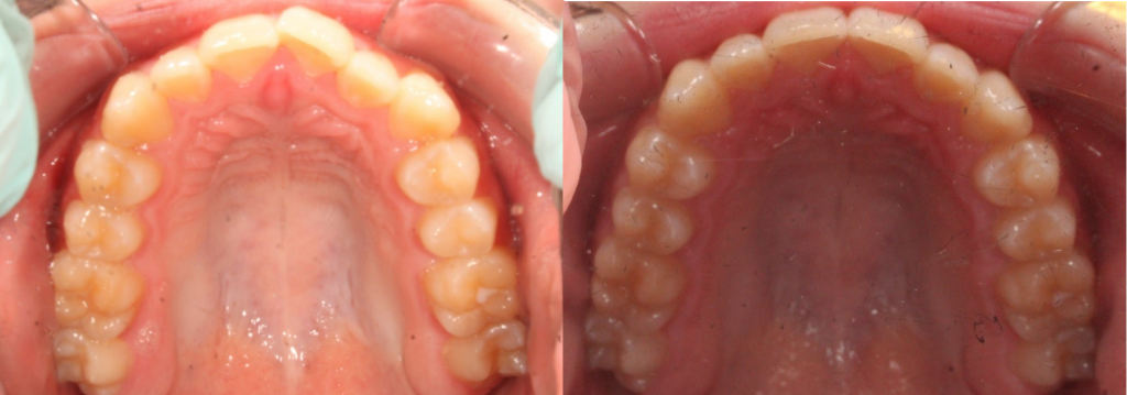 Mckinney Orthodontics Invisalign 6