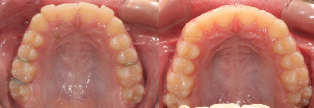 Mckinney Orthodontics Invisalign 7