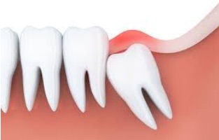 Mckinney Orthodontist Wisdom Teeth Removal